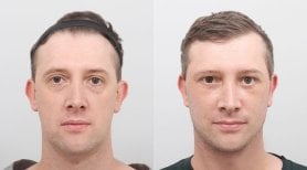Facelift before and after results at AB PLASTIC SURGERY, visible facial rejuvenation