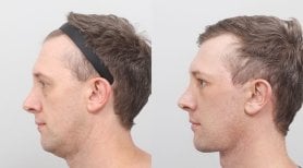 Before and after facelift results at AB PLASTIC SURGERY, visible facial contour improvement