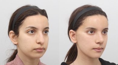 Facelift before and after results at AB PLASTIC SURGERY, visible facial rejuvenation
