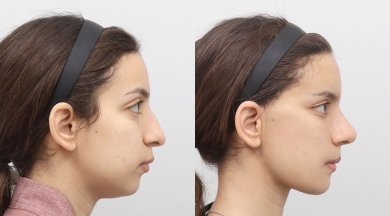 Facelift before and after results at AB PLASTIC SURGERY – visible facial contour improvement