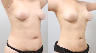 Результаты до и после контурирования тела BodyTite в AB PLASTIC SURGERY, живот и талия