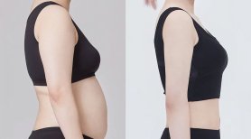 Результати до і після BodyTite-контурингу тіла в AB PLASTIC SURGERY, струнка талія