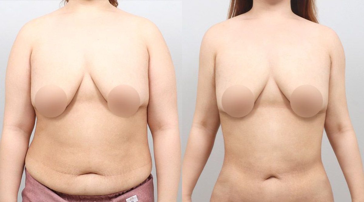Resultados antes y después de BodyTite en AB PLASTIC SURGERY, abdomen más delgado
