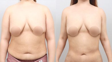Результаты до и после контурирования тела BodyTite в AB PLASTIC SURGERY, похудение живота