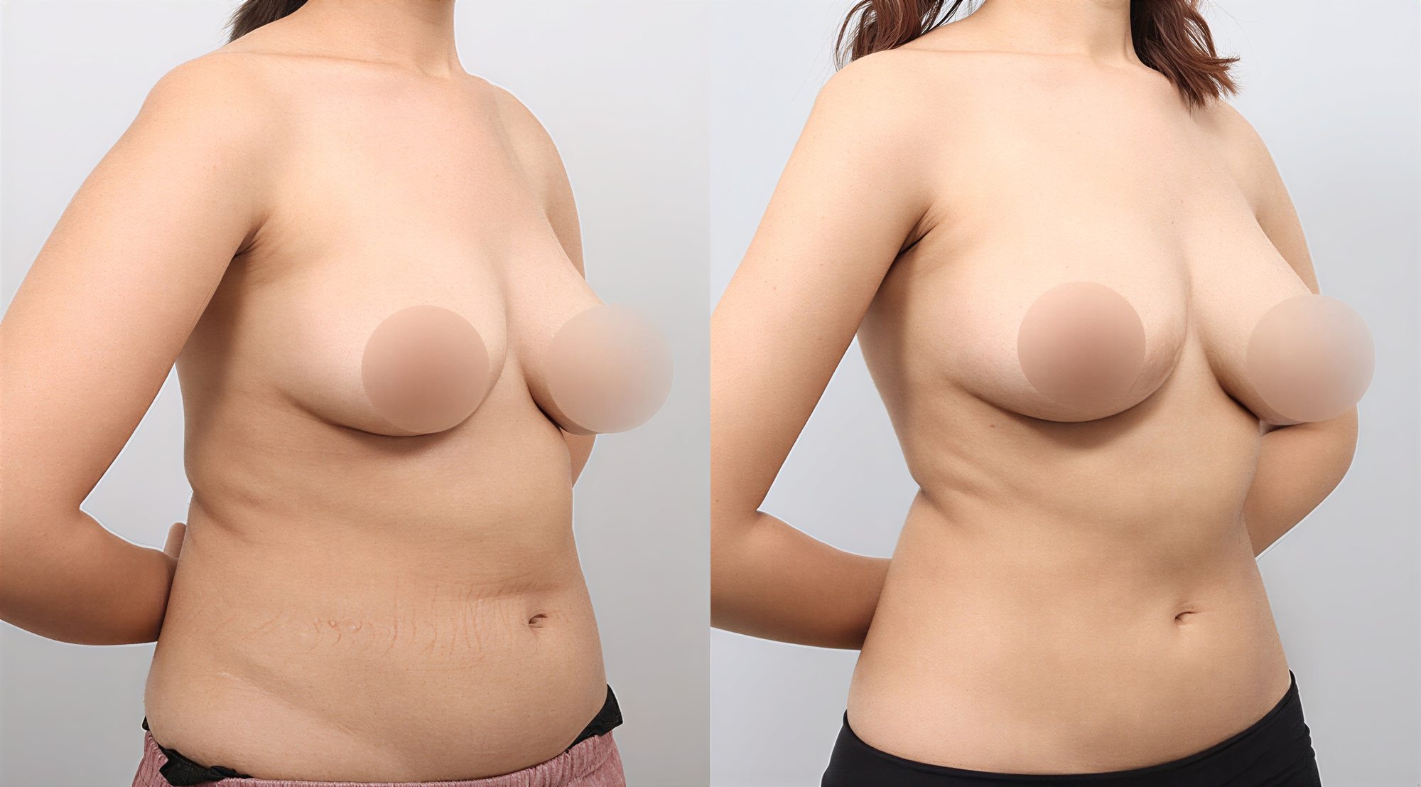 Resultados antes y después de BodyTite en AB PLASTIC SURGERY, silueta mejorada