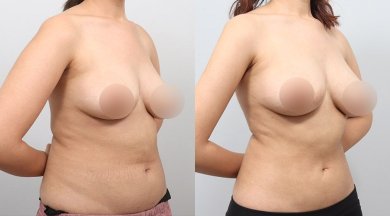 Результаты до и после контурирования тела BodyTite в AB PLASTIC SURGERY, улучшенный силуэт