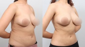 Результаты до и после контурирования тела BodyTite в AB PLASTIC SURGERY, улучшенный силуэт