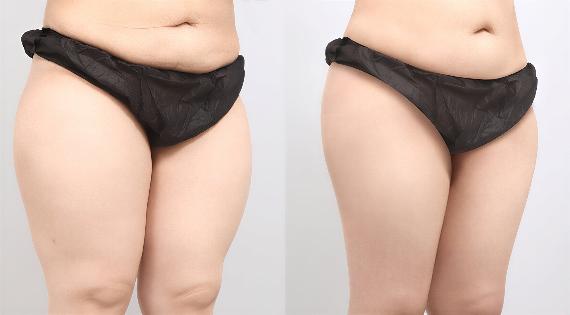 Resultados antes y después de BodyTite en AB PLASTIC SURGERY, abdomen y muslos