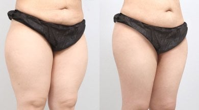 Before and after BodyTite body contouring results at AB PLASTIC SURGERY, abdomen and thighs