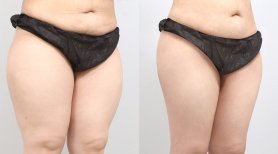 Before and after BodyTite body contouring results at AB PLASTIC SURGERY, abdomen and thighs