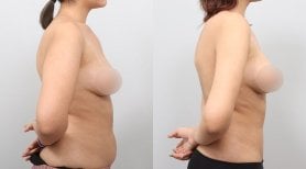 Before and after BodyTite body contouring results at AB PLASTIC SURGERY, abdomen slimming