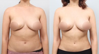 Результаты до и после контурирования тела BodyTite в AB PLASTIC SURGERY, живот и талия
