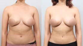Результаты до и после контурирования тела BodyTite в AB PLASTIC SURGERY, живот и талия