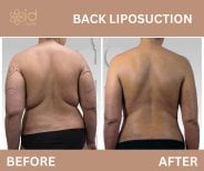 نتائج قبل وبعد شفط دهون الظهر بتقنية فايزر في ID Clinic Bangkok وتحسن شكل الجسم