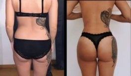 Before and after back liposuction results at Dr. Safa Manav Clinic, improved body contour
