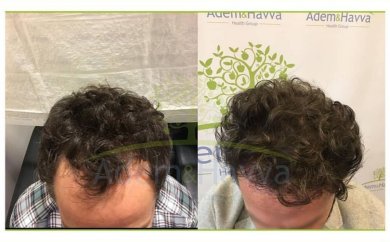 Vorher-nachher-Ergebnisse der DHI-Haartransplantation bei Adem and Havva Medical Center, verbesserter Haaransatz