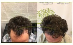 Vorher-nachher-Ergebnisse der DHI-Haartransplantation bei Adem and Havva Medical Center, verbesserter Haaransatz