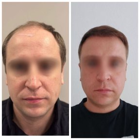 Vorher-nachher-Ergebnis DHI-Haartransplantation bei Adem and Havva Medical Center, vollere Haarlinie