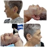 Facelift before and after results at Hospital de la Familia, visible facial rejuvenation effect