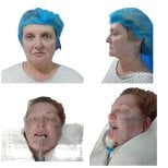 Facelift before and after results at Hospital de la Familia, visible facial rejuvenation outcome
