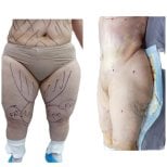 نتائج شفط الدهون قبل وبعد في مستشفى دي لا فاميليا، تحديد الفخذين والبطن