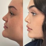 Vorher-nachher-Ergebnis der Nasenkorrektur in der Dr. Safa Manav Clinic, Profilverbesserung