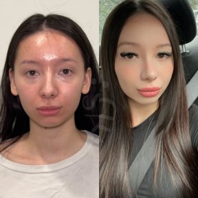 Vorher-nachher-Ergebnisse der Nasenkorrektur in der Dr. Safa Manav Klinik, Nasenform verbessert