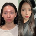 Vorher-nachher-Ergebnisse der Nasenkorrektur in der Dr. Safa Manav Klinik, Nasenform verbessert