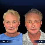 Before and after neck lift results at Dr. Safa Manav Clinic, visible neck and jawline improvement