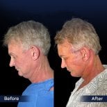 Before and after neck lift results at Dr. Safa Manav Clinic, visible jawline and neck contour