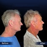 Before and after neck lift results at Dr. Safa Manav Clinic, visible neck tightening effect