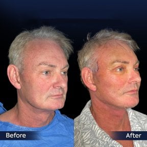 Before and after neck lift results at Dr. Safa Manav Clinic, visible jawline and neck contour