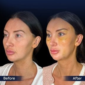 Vorher-nachher-Ergebnis Brauenlifting bei Dr. Safa Manav Clinic, sichtbare Anhebung