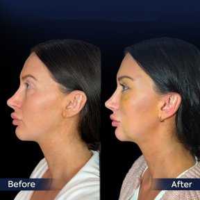 Vorher-nachher-Ergebnis Brauenlifting bei Dr. Safa Manav Clinic, sichtbare Stirnstraffung