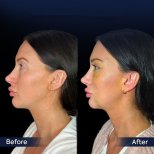 Vorher-nachher-Ergebnis Brauenlifting bei Dr. Safa Manav Clinic, sichtbare Stirnstraffung