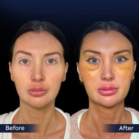 Vorher-nachher-Ergebnis Brauenlifting bei Dr. Safa Manav Clinic, sichtbare Anhebung