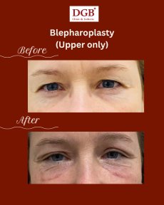 Résultats avant/après blépharoplastie des paupières supérieures à DGB Clinic, rajeunissement du regard