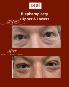 Résultats avant/après blépharoplastie des paupières inférieures à DGB Clinic, poches réduites