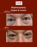 Résultats avant/après blépharoplastie des paupières inférieures à DGB Clinic, poches réduites