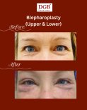 Résultats avant/après blépharoplastie des paupières inférieures à DGB Clinic, rajeunissement