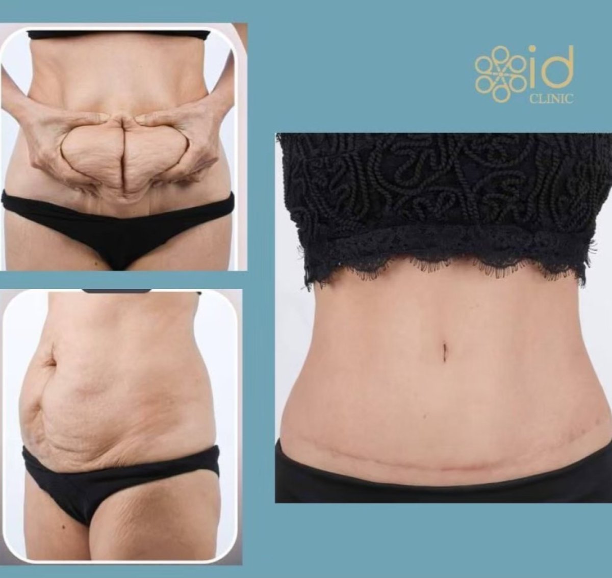 Resultados antes y después de mommy makeover en ID Clinic Bangkok – abdomen firme y contorneado