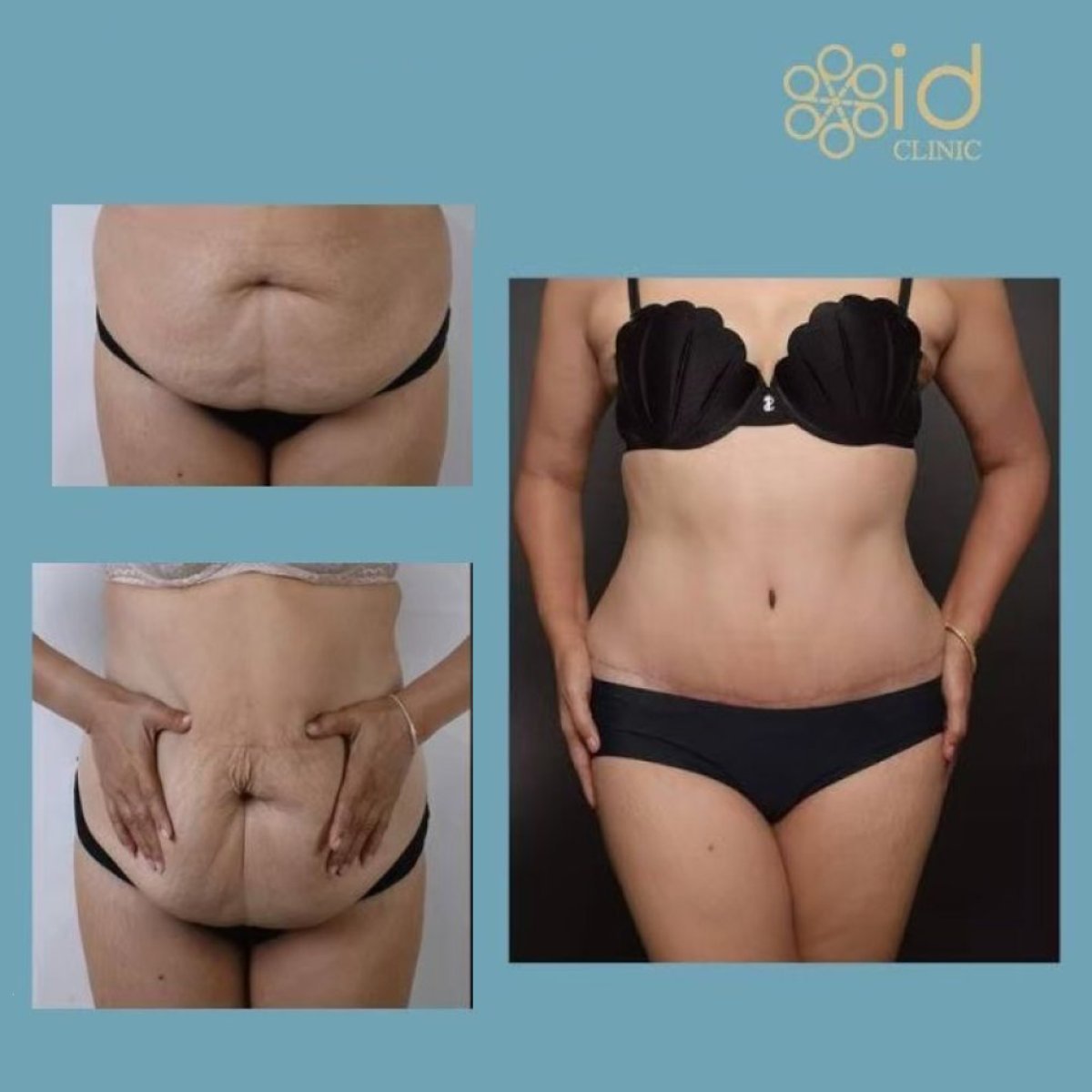 Resultados antes y después de mommy makeover en ID Clinic Bangkok – contorno abdominal visible