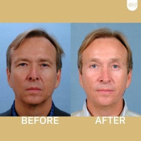 Before and after facelift results at ID Clinic Bangkok, visible facial rejuvenation and lifting