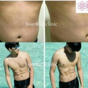 360 liposuction before and after results at ID Clinic Bangkok, visible abdominal contouring