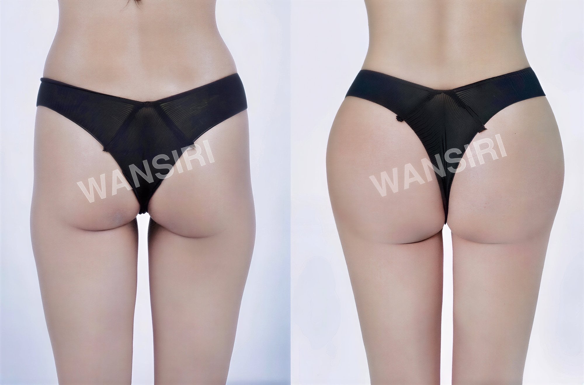 Resultados antes y después de Brazilian Butt Lift en Wansiri Hospital, glúteos realzados