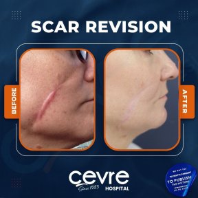 Narbenkorrektur Vorher-Nachher-Ergebnisse im Cevre Hospital, verbesserte Gesichtsnarbe
