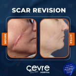 Narbenkorrektur Vorher-Nachher-Ergebnisse im Cevre Hospital, verbesserte Gesichtsnarbe