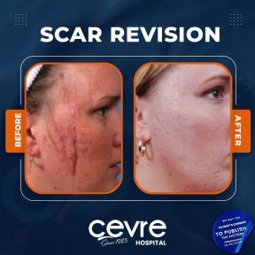 Vorher-nachher-Ergebnisse der Narbenkorrektur bei Adem and Havva Medical Center, verbesserte Gesichtshaut