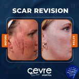 Vorher-nachher-Ergebnisse der Narbenkorrektur bei Adem and Havva Medical Center, verbesserte Gesichtshaut