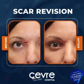 Narbenkorrektur Vorher-Nachher-Ergebnis bei Adem and Havva Medical Center, verbesserte Stirnnarbe